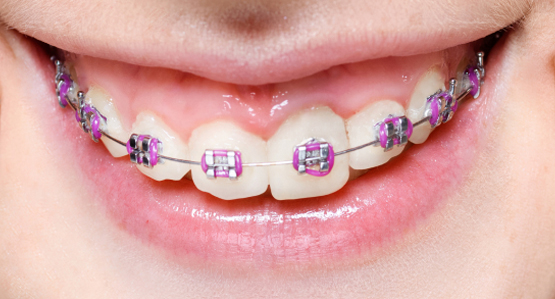Brackets metálicos